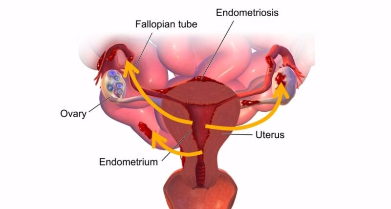 Endometriosis