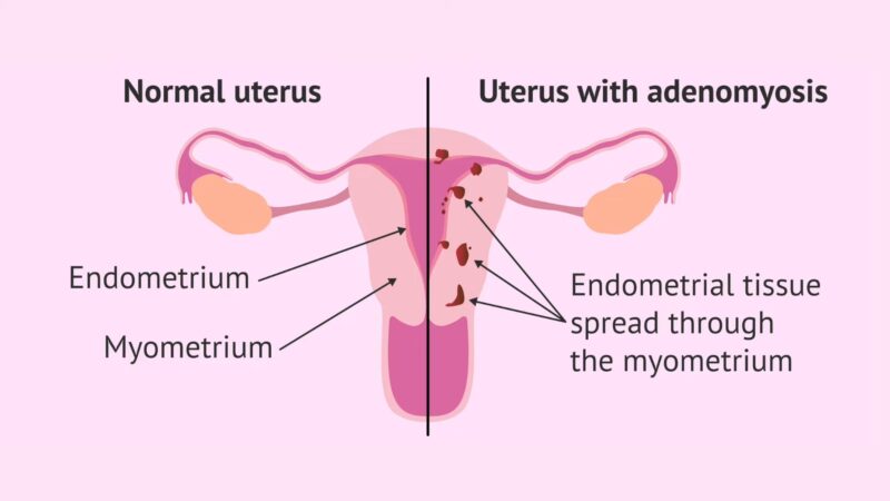 adenomyosis