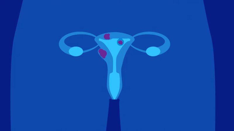 uterine Fibroids